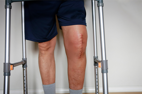 Post-surgical knee scar with patient using a walker for support